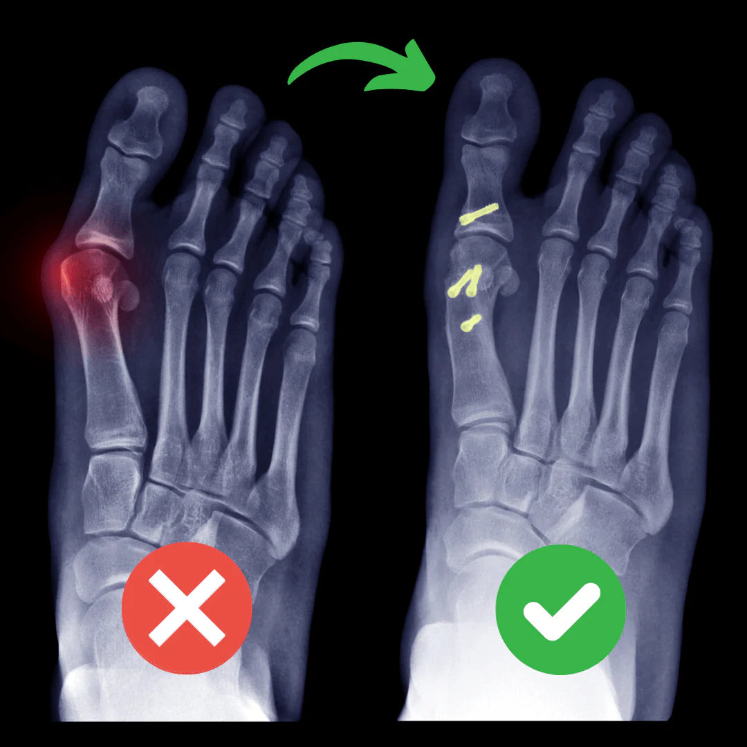 Natural Bunion Corrector
