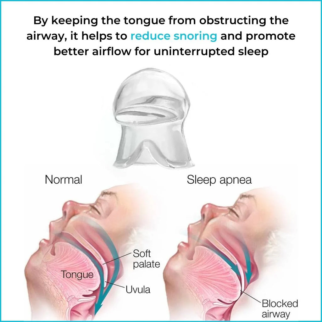Anti Snoring Device