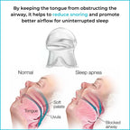 Anti Snoring Device