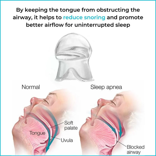 Anti Snoring Device